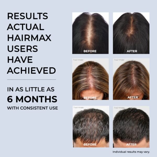Обруч с лазером для роста волос (США) HairMax LaserBand 41 - Image 3